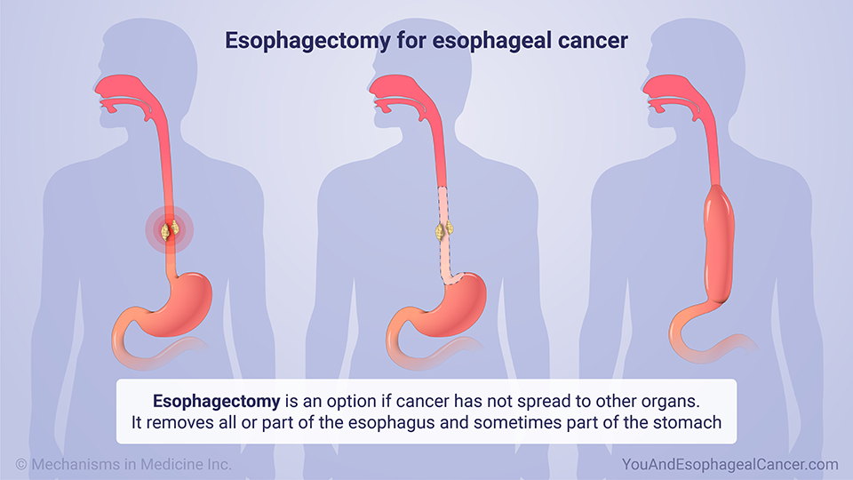 Esophagectomy for esophageal cancer