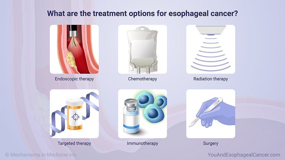 What are the treatment options for esophageal cancer?